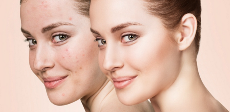 serum thảo mộc trị mụn