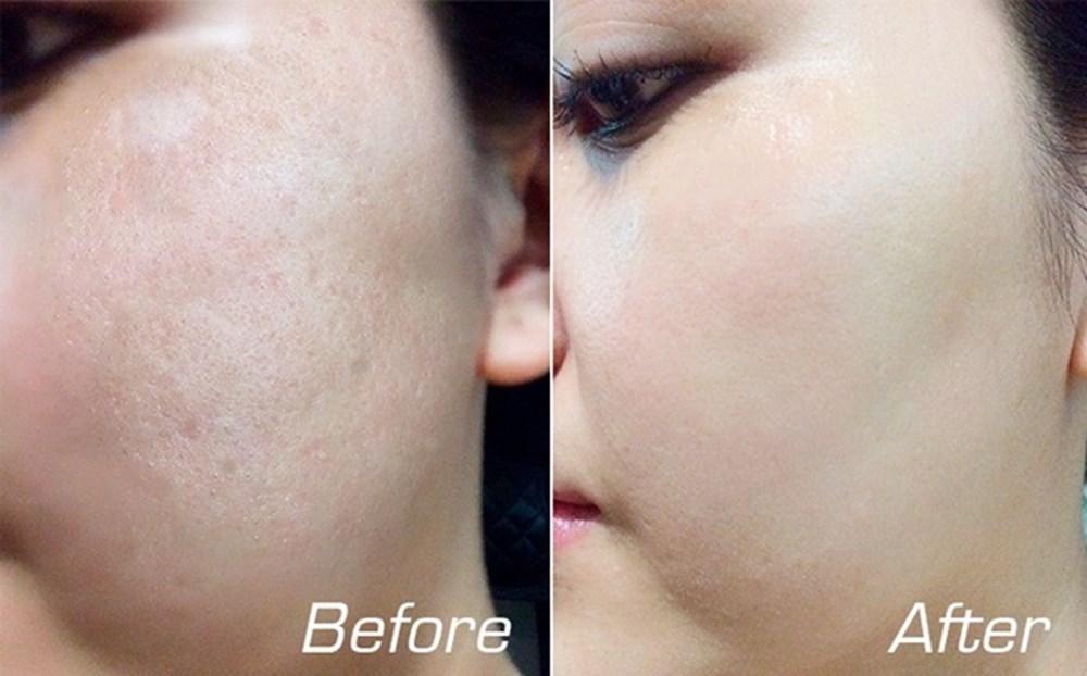 làm mờ sẹo rỗ